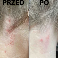Dermz Healpsorin - zestaw na łuszczycę, ŁZS i podrażnioną skórę głowy szampon 500ml i odżywka 500ml