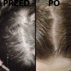 Dermz Healpsorin - zestaw na łuszczycę, ŁZS i podrażnioną skórę głowy szampon 500ml i odżywka 500ml